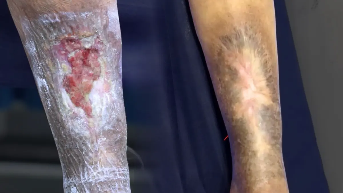 Heridas y úlceras que no cicatrizan